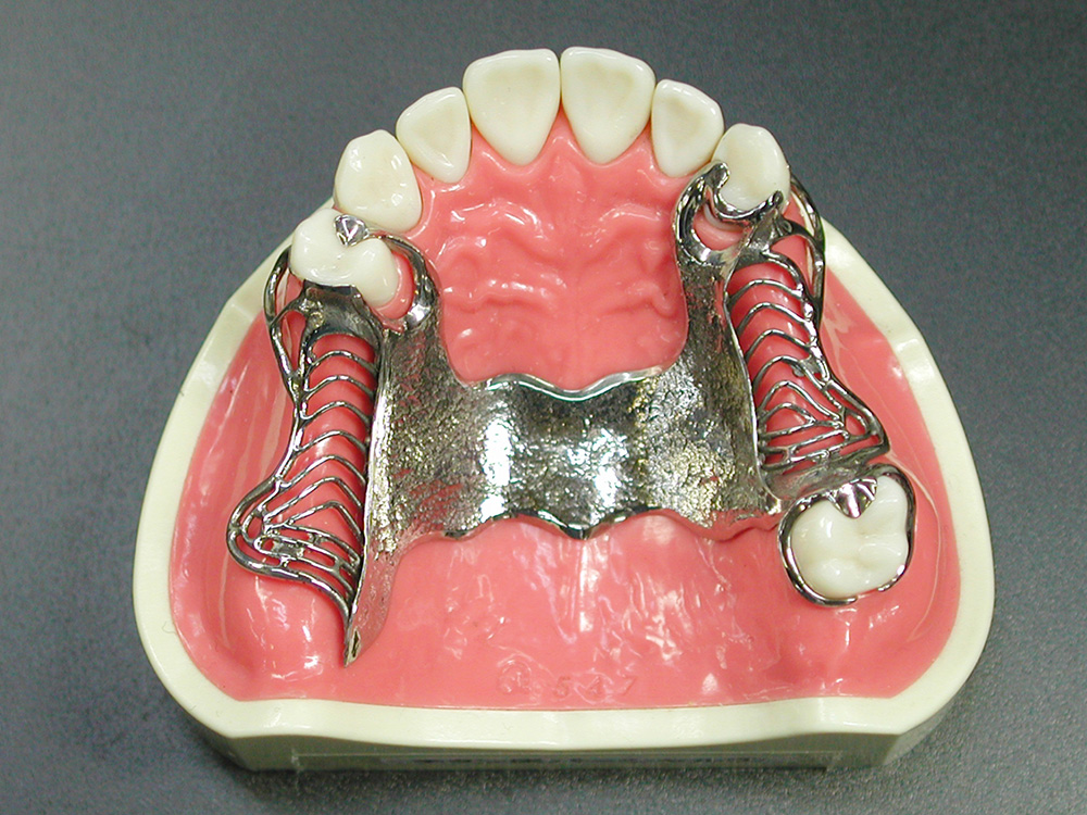 金属床義歯（きんぞくしょうぎし）
