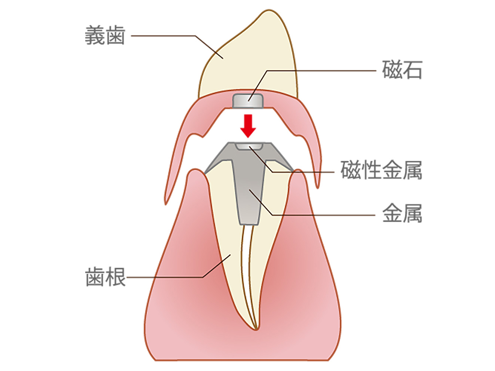 磁石式入れ歯（マグネットデンチャー）